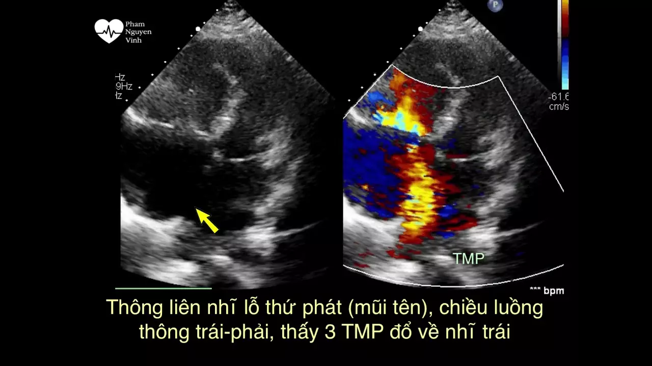 Hình ảnh thông liên nhĩ thấy rõ trên siêu âm.webp